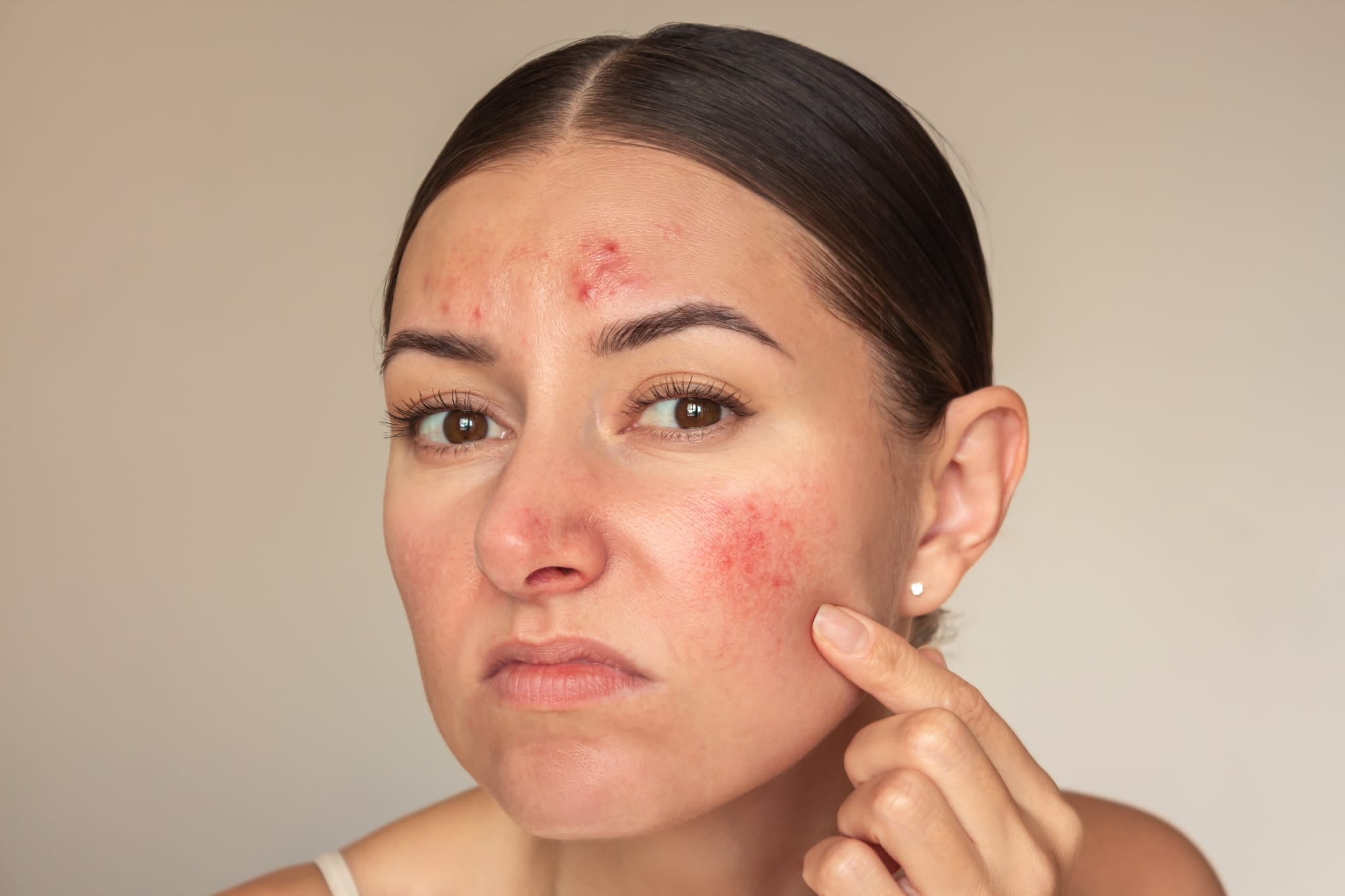 Rosacea - wenn deine Haut rot sieht